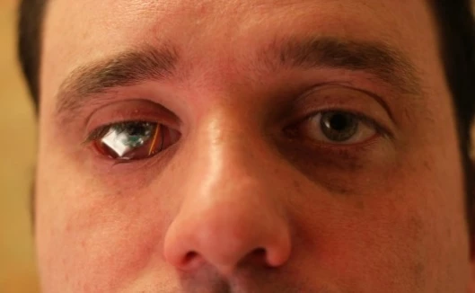 Canadian filmmaker Rob Spence tests the video camera inside a false eye