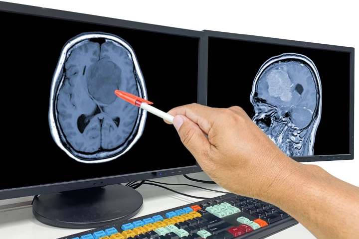 Researchers have found that a 60-year-old antipsychotic drug reverses treatment resistance in a particularly nasty type of brain cancer