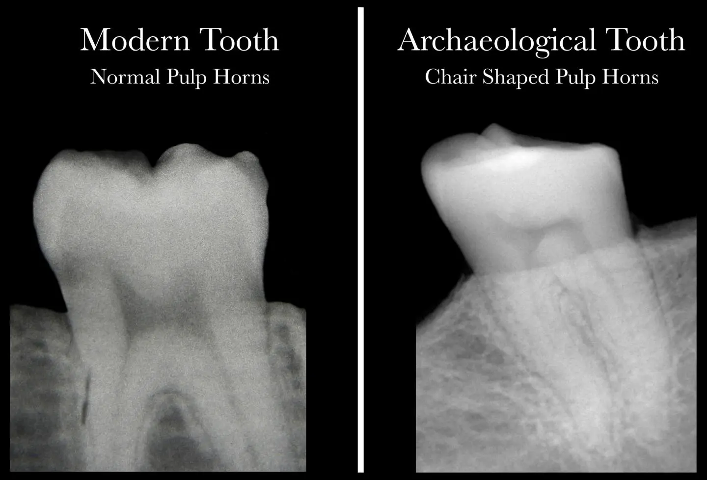 A modern healthy tooth with pulp "horns" (left), and an archeological tooth indicating a lack of vitamin D