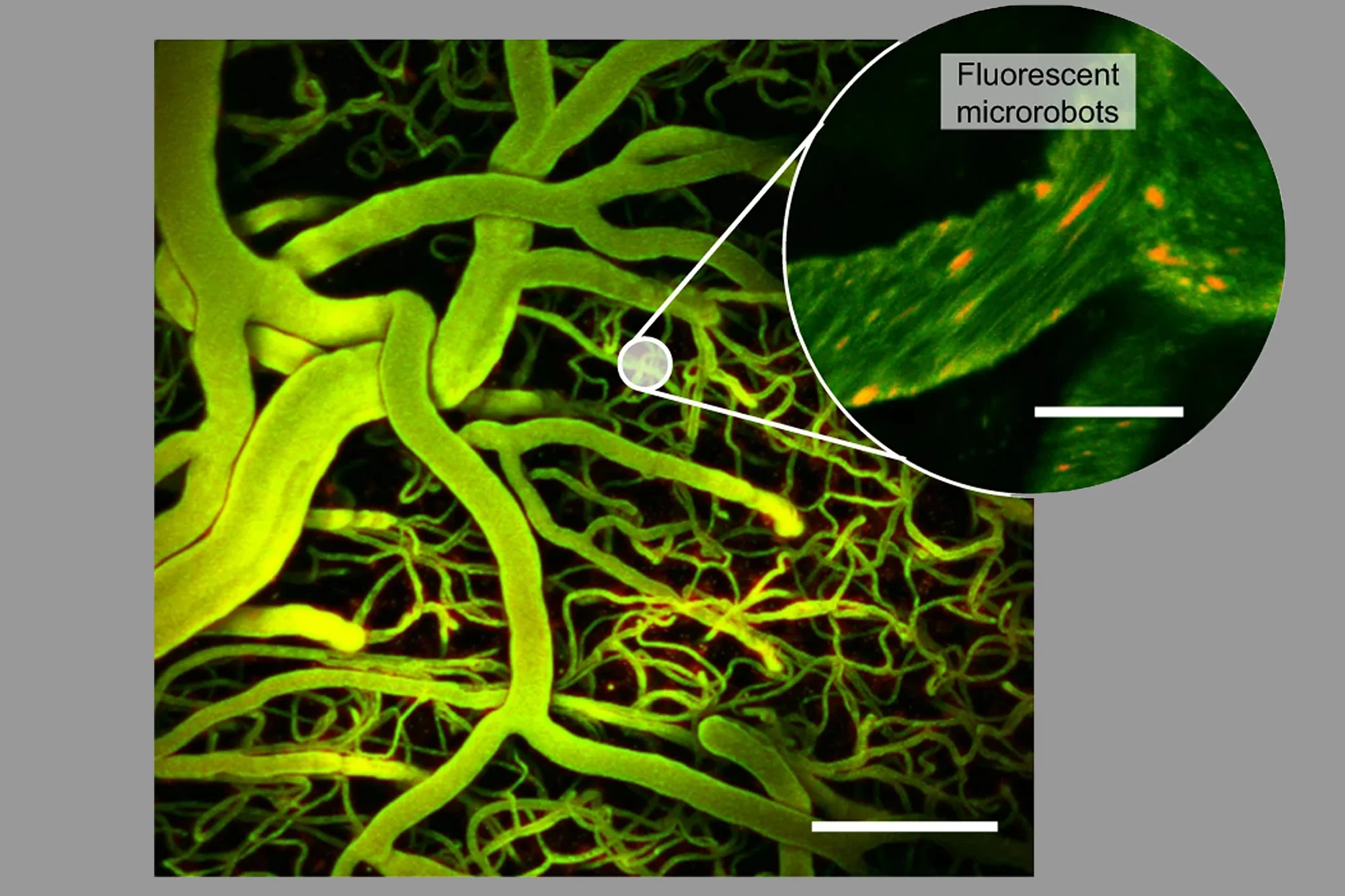 Researchers have developed a microrobot that can be navigated through the brain's blood vessels using ultrasound