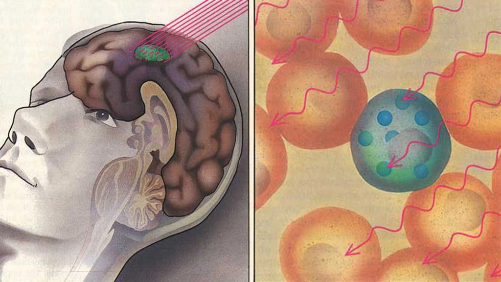 Boron neutron capture therapy can kill tumors without harming healthy neighboring tissue