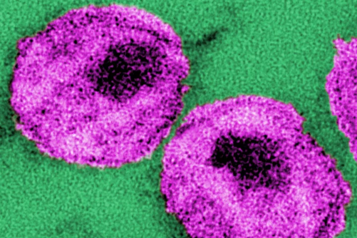 A number of HIV particles, or virions that could be targeted and killed using engineered human blood stem cells (Photo: CDC/ Dr. A. Harrison; Dr. P. Feorino)