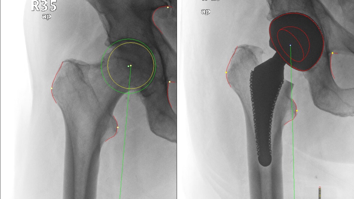 Custom software advises the surgeon on what size of implant to select, based on patient X-rays and rotational measurements
