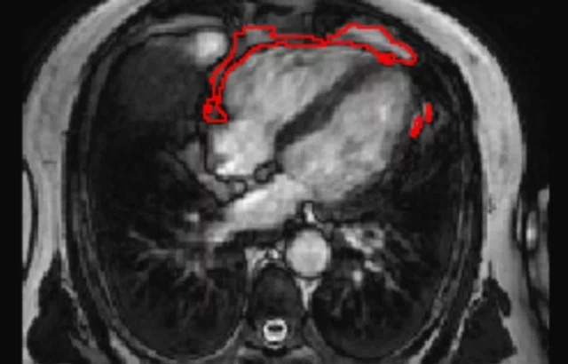 An example of the fat deposits detected by the new tool