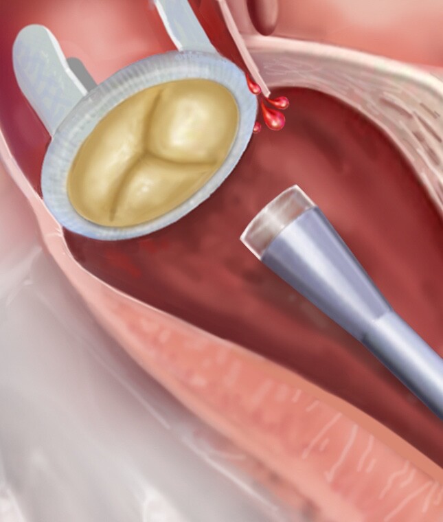 The catheter nears the leak