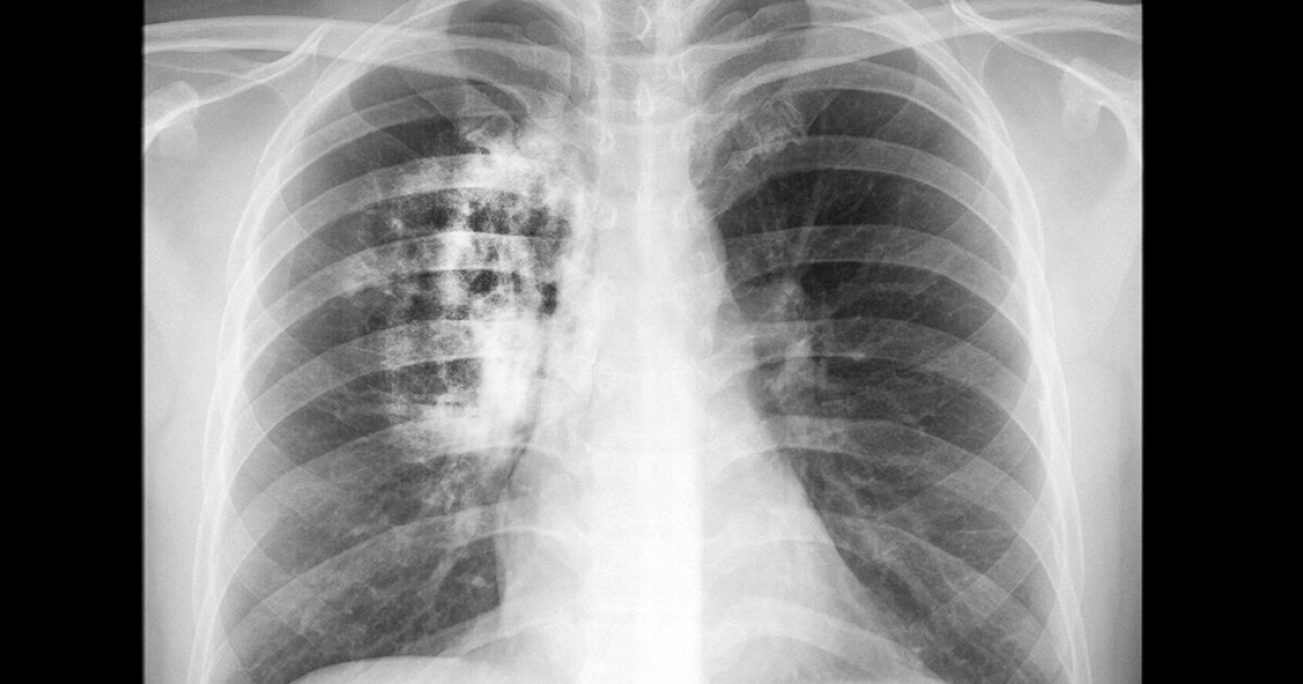 Protein could enable blood test to detect lung cancer in its early stages