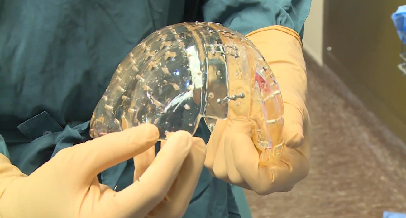 A woman's skull has been successfully replaced with a 3D-printed implant