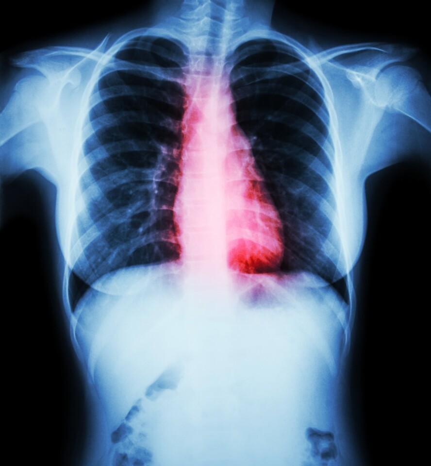 Researchers are exploring how iPSCs can be used to repair damaged hearts