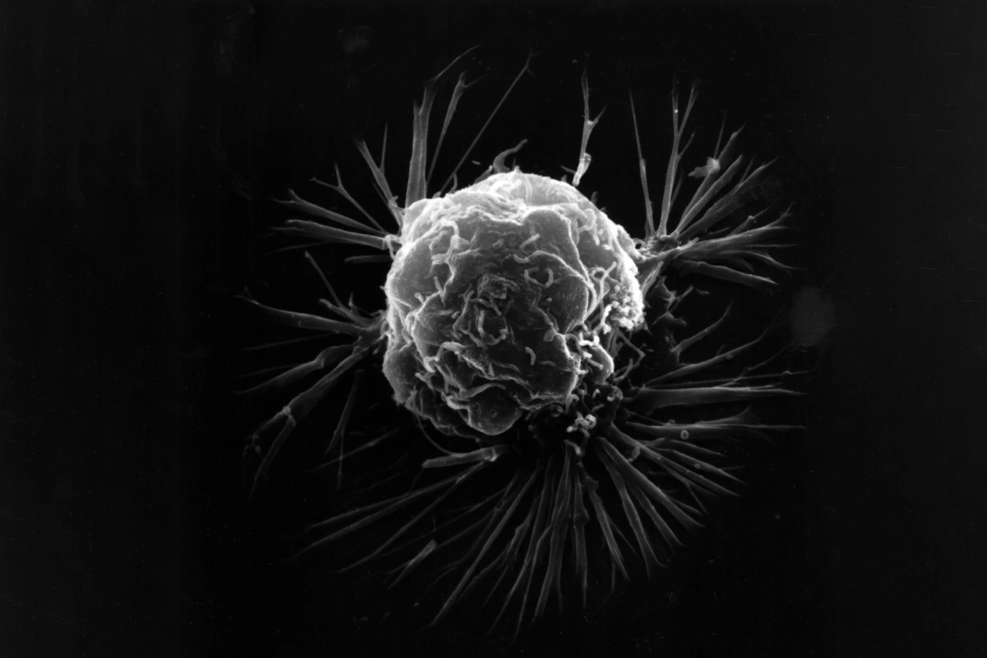 A breast cancer cell