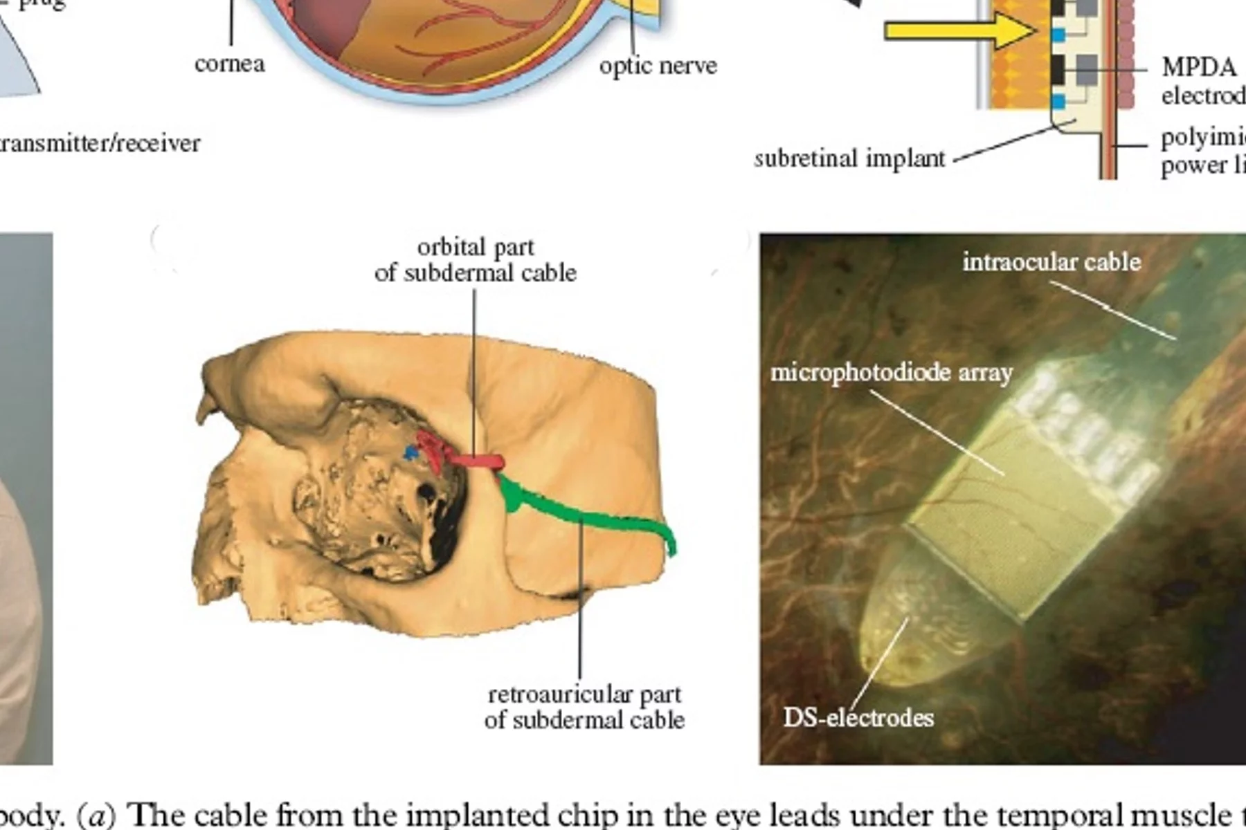 How the device is implanted (Image: Retinal Implant AG)