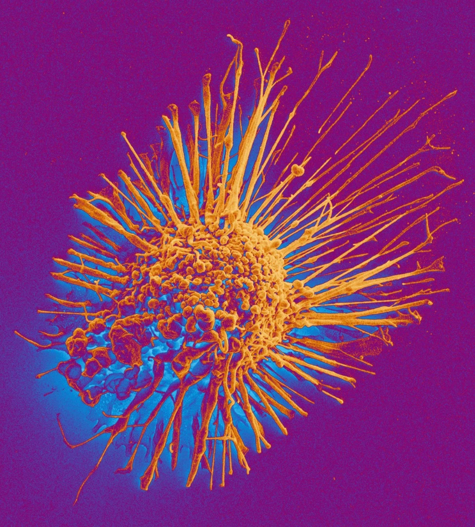 An electron microscopy image of a cancer cell produced at the University of Basel