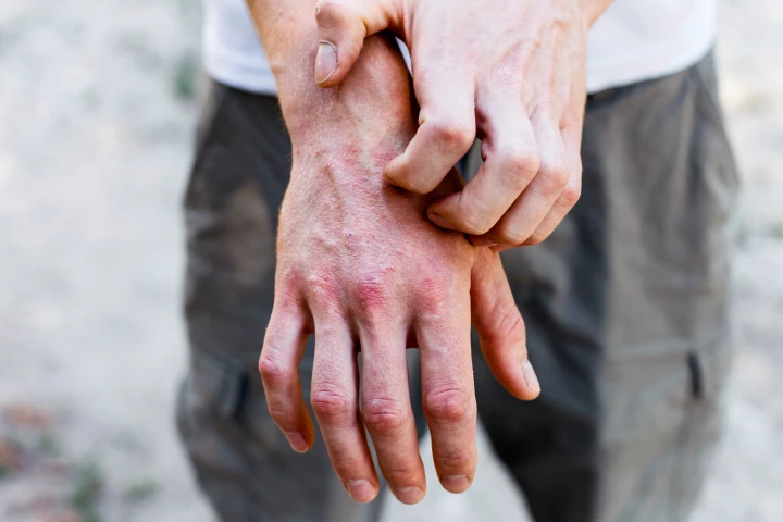 A new immunotherapy injection has provided significant relief to eczema sufferers