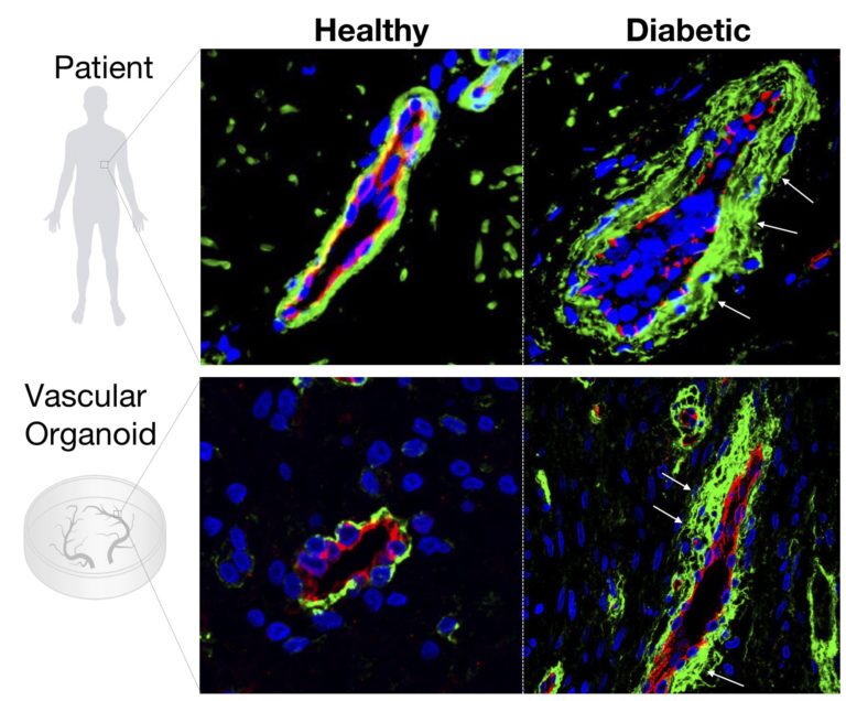 When exposed to hyperglycemia the lab-grown blood vessels (in red) show the same enlarged membrane (in green) as live, diabetic patients
