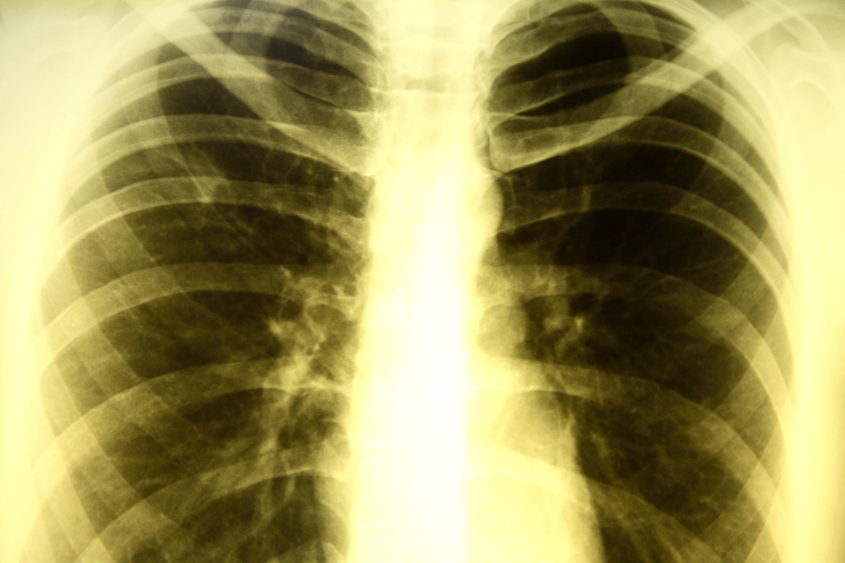 A team of international researchers has turned to stem cells in a quest to find an a more effective treatment for patients with resistant tuberculosis (Image: Shutterstock)