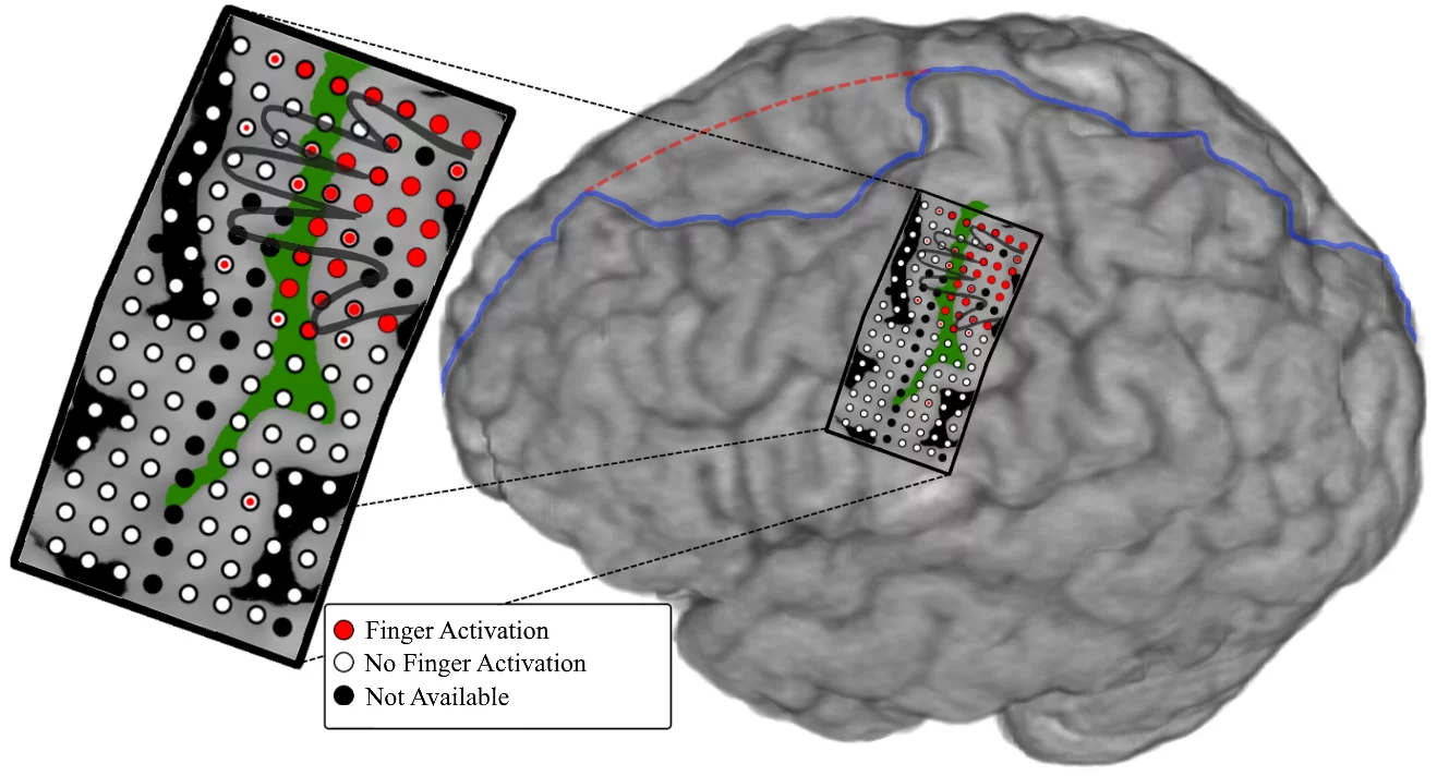 Researchers implanted an array of 128 electrodes over the part of the brain controlling hand and arm movements