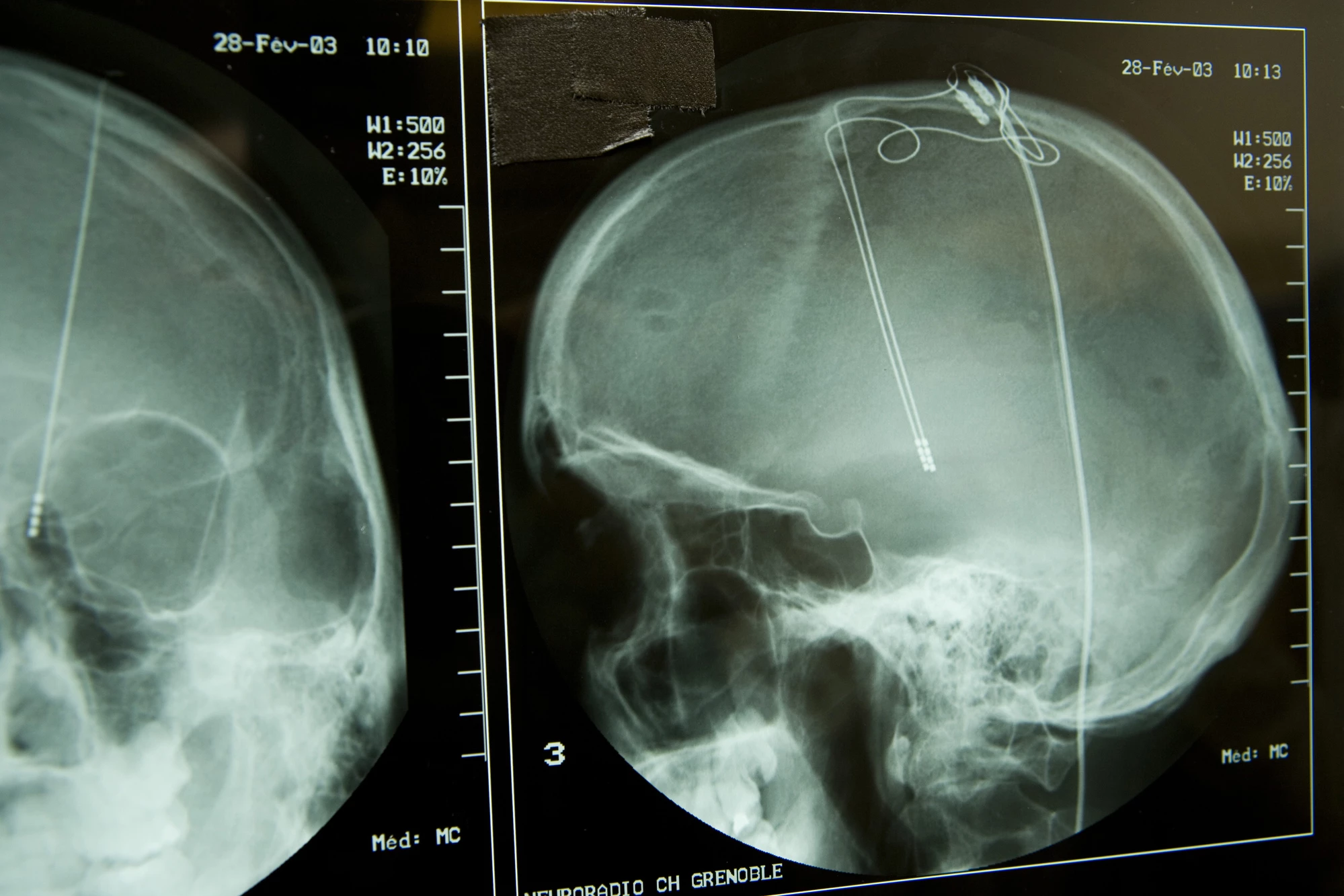 A new study has provided the first evidence to suggest Parkinson’s patients are helped by deep brain stimulation due to the treatment directly increasing dopamine levels