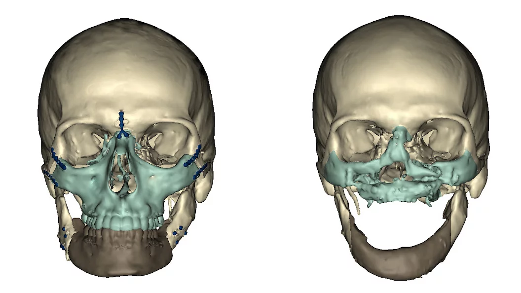 CT scan before and after surgery (Image: University of Maryland Medical Center)