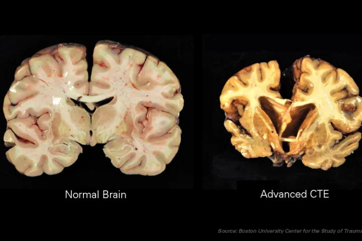 A normal brain, as compared to one with advanced chronic traumatic encephalopathy