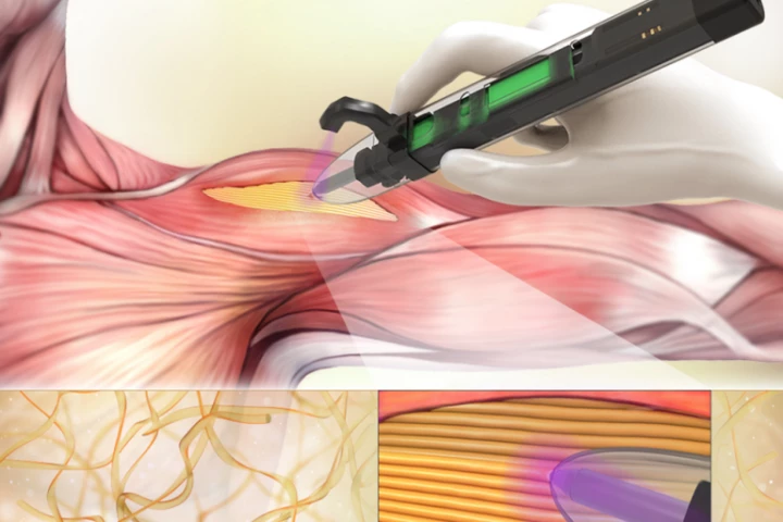 An illustration of the device, with its fibrous scaffolding depicted at bottom-left