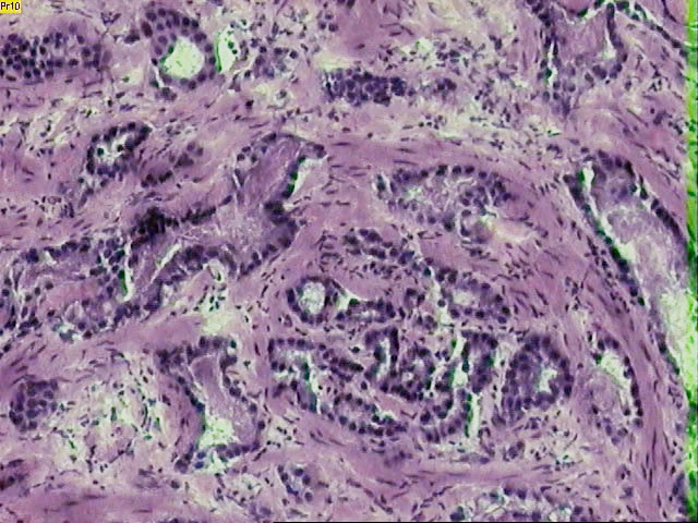 An electronic nose developed by Finnish researchers is capable of distinguishing between prostate cancer and benign disease and could result in a less invasive approach to diagnosis