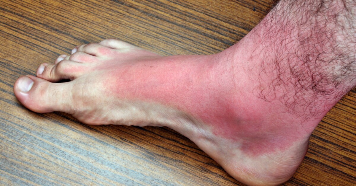 Vitamin D a new sunburn treatment?