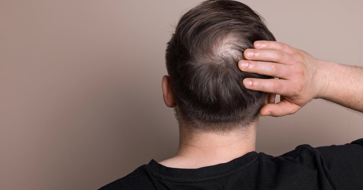 First long-acting hair regrowth pill hailed as 'new benchmark'
