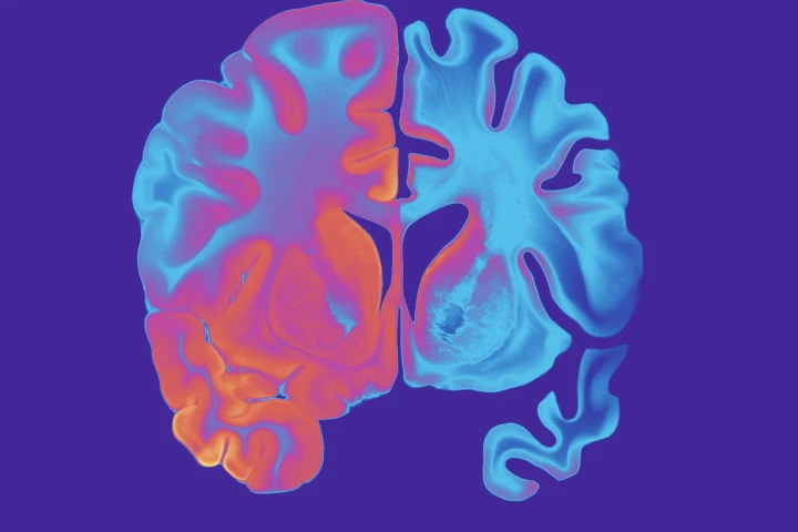 Comparisons of a healthy brain and one with Alzheimer's