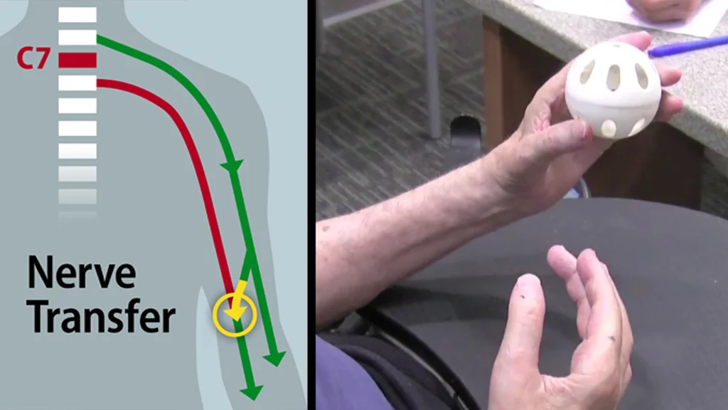 Surgeons have restored some hand function to a quadriplegic patient by rerouting nerves in the patient’s upper arm to bypass the block at their C7 spinal cord injury
