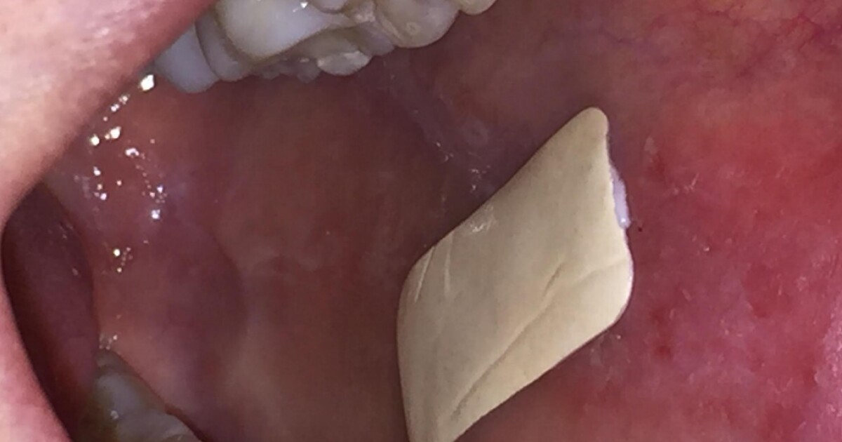 Drugdispensing "mouth bandage" sticks it to sores