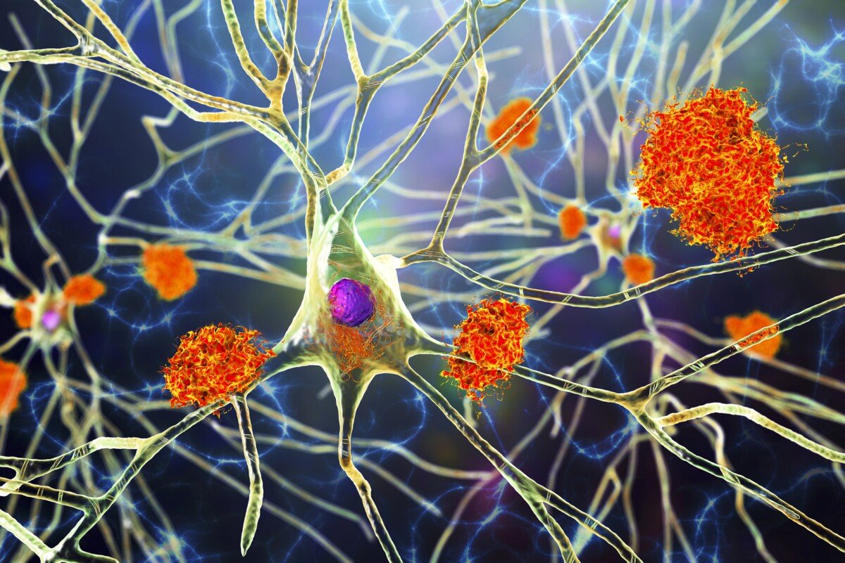 Novel Alzheimer's treatment clears brain plaques with light and oxygen