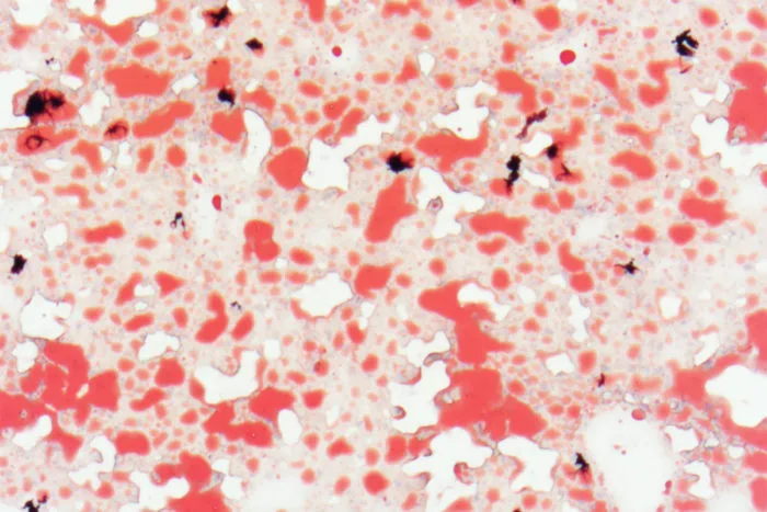 An image of the livers of mice fed a high-fat diet, showing many fatty deposits (red) – new research may have found a natural sugar that can reduce these build-ups and treat metabolic syndrome