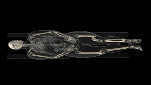 The data set shows a full-body examination of a traffic accident victim. The examination gives the viewer a good and quick understanding of the 3D post-mortem anatomy and a possible cause of death, in this case a broken neck