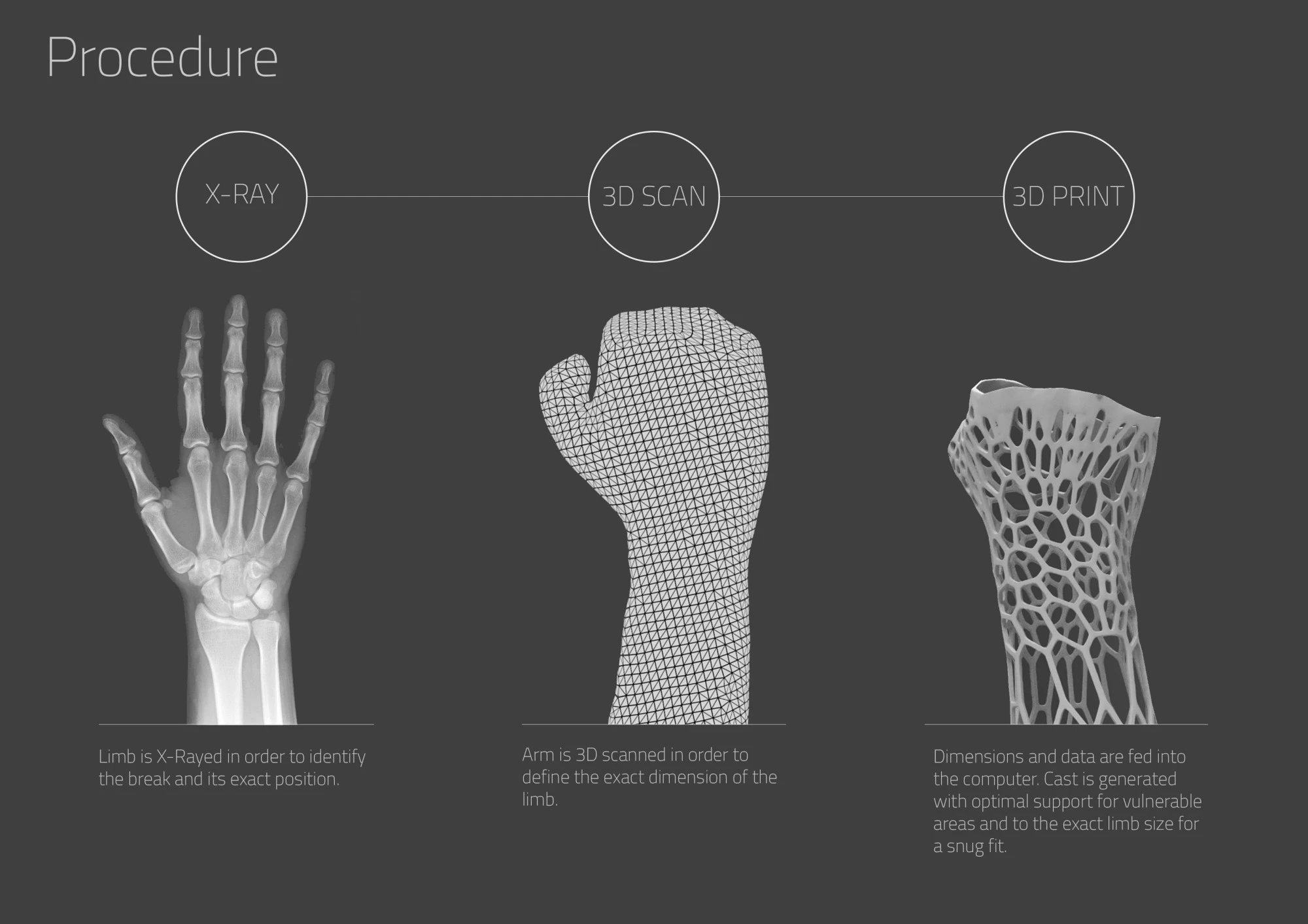 The Cortex cast utilizes the X-ray and 3D scan of a patient with a fracture to generate a 3D-printed model in relation to the point of fracture