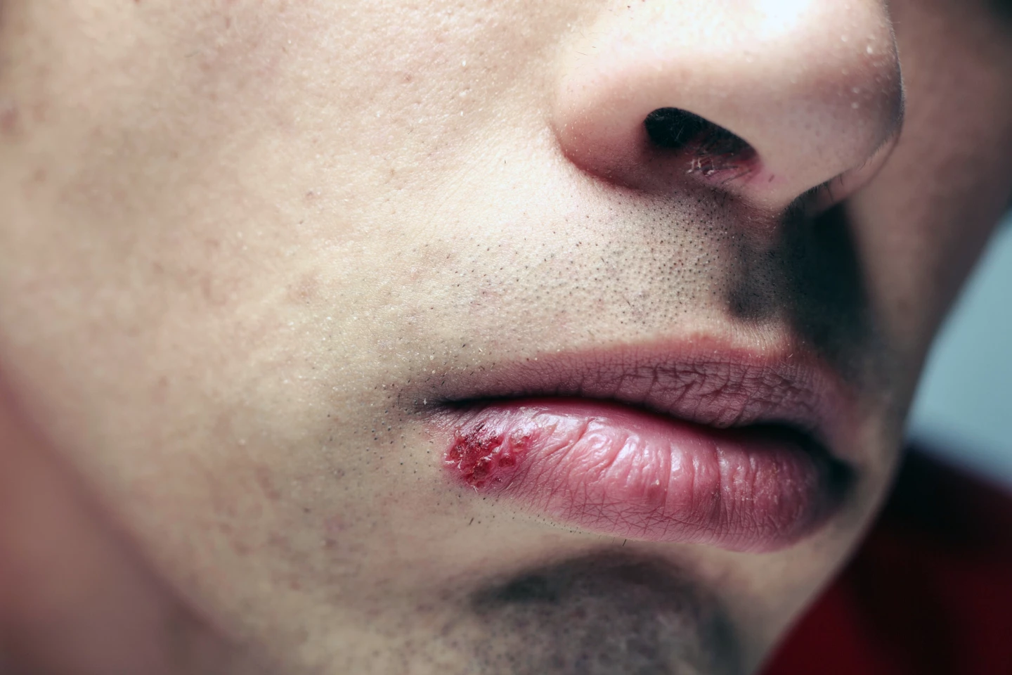 HSV-1 is mostly responsible for cold sores but can be transmitted through sexual activity
