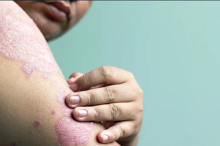 One topical foam effectively treats psoriasis in two places: the body and the scalp