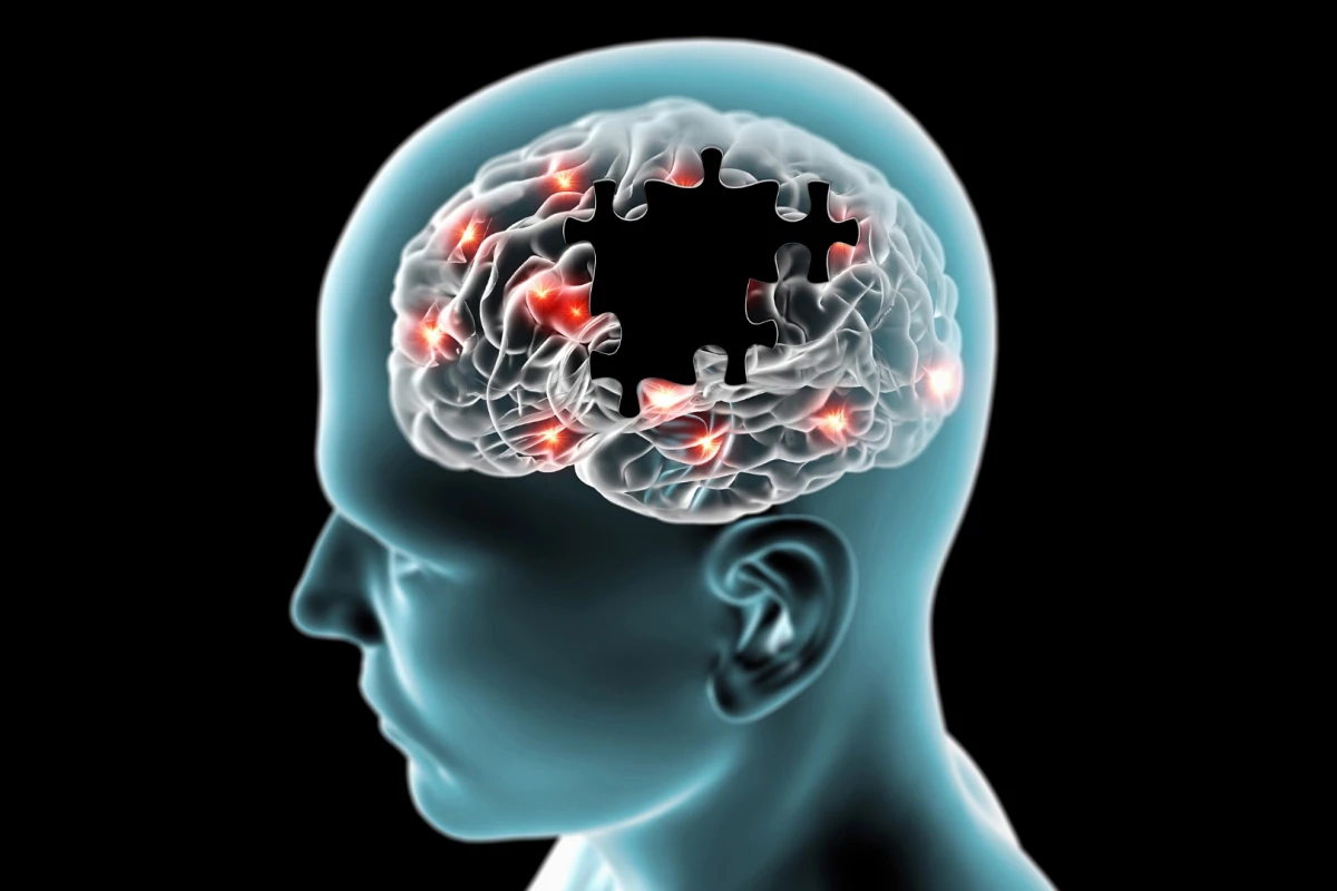 New research has revealed frontotemporal dementia results in a person losing the ability to daydream or let their mind wander
