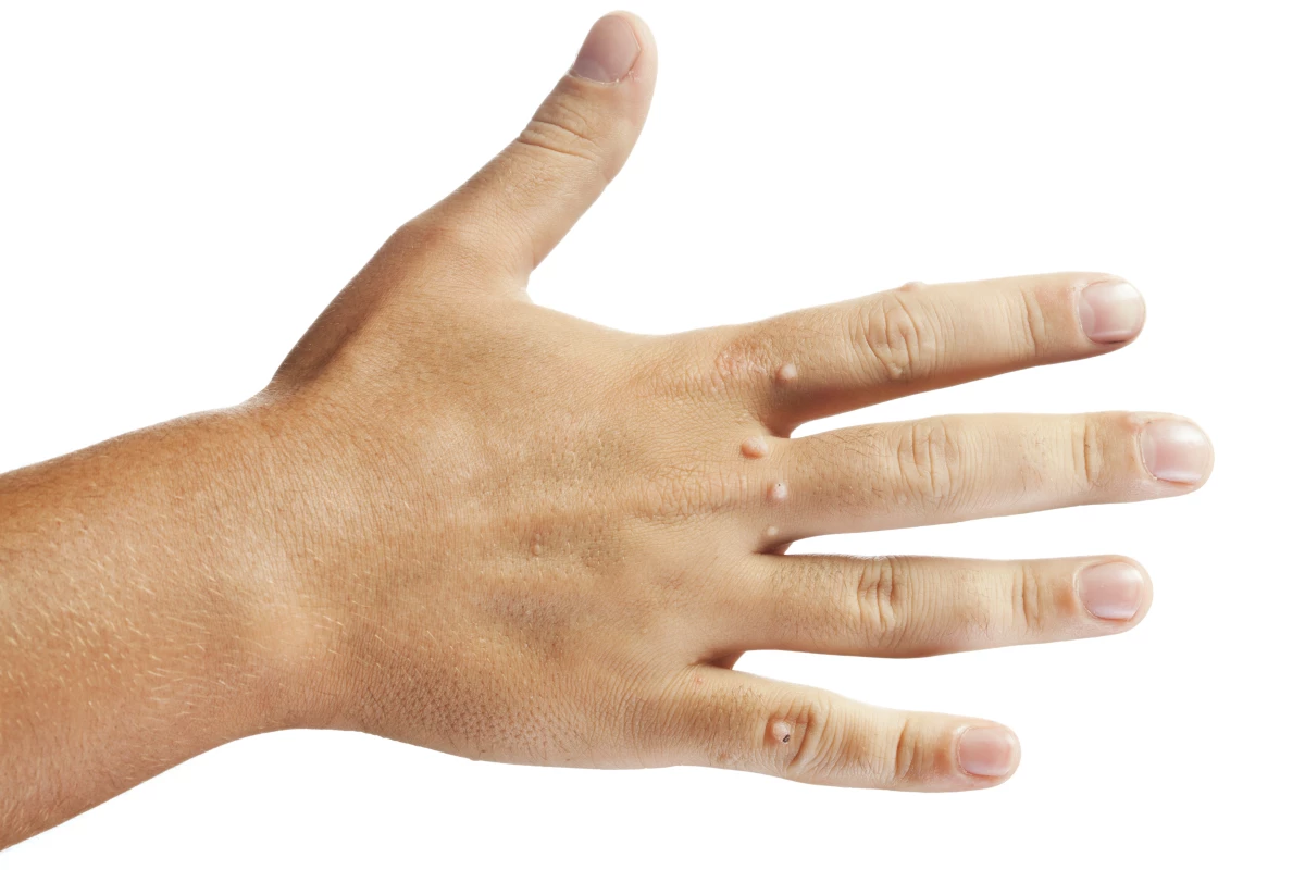 Treatment-resistant warts, along with other skin lesions, may be no match for nano-pulse stimulation