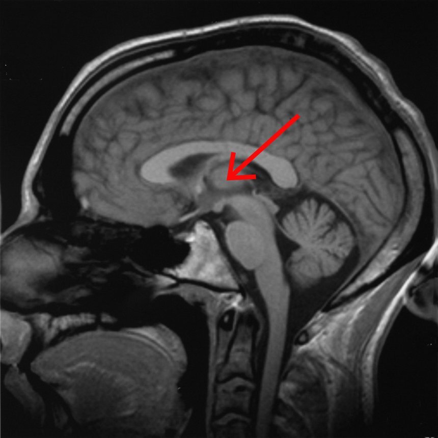 The central lateral thalamus is found deep in the center of the brain, close to the brain stem
