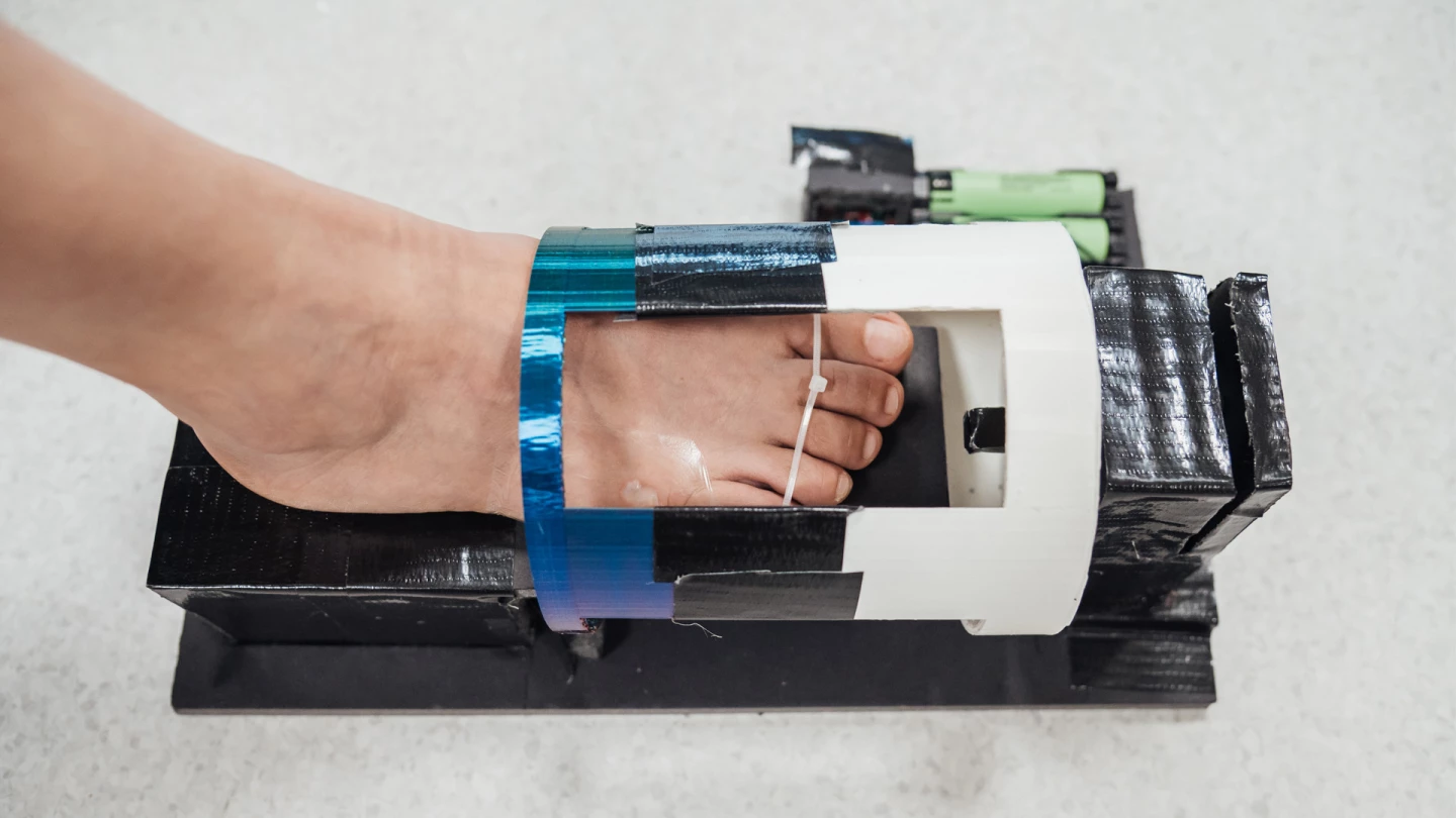 Treatment would involve placing the injured foot in the magnetic stimulation device for a period of two to three hours