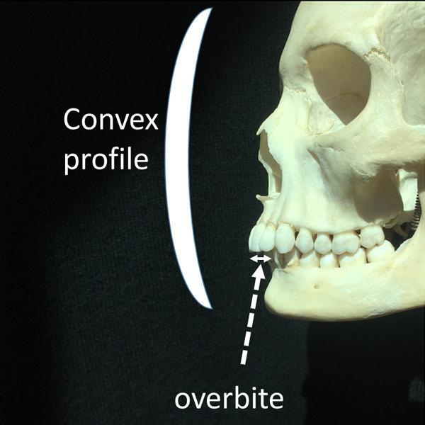 Slender lower jaws are also associated with overbites