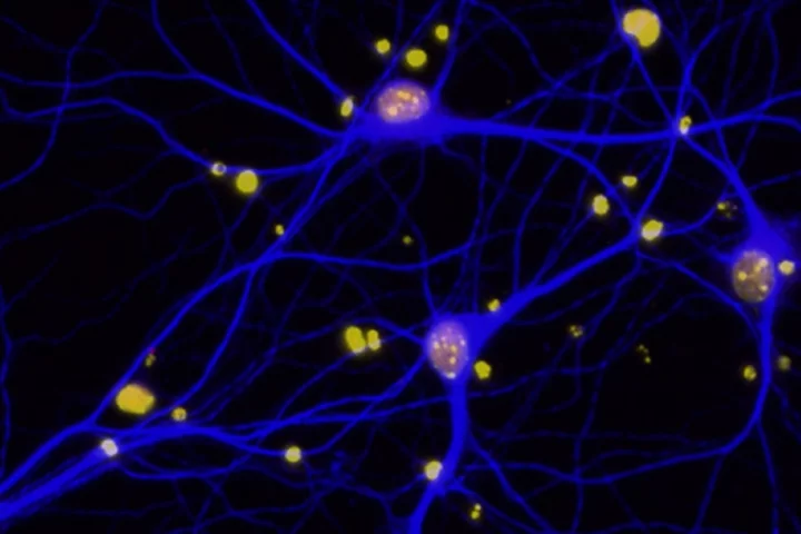 The study found that amyloid-beta plaques in the brain reduce levels on the protein BRCA1 (red) in neurons (blue)