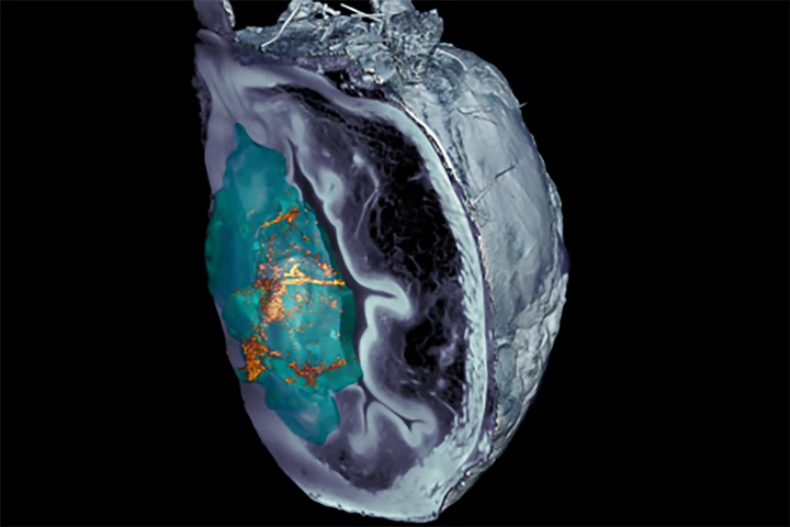 Researchers have developed self-propelled nanobots (orange) powered by a waste substance in urine that penetrate bladder tumors (green) to deliver their radioactive treatment