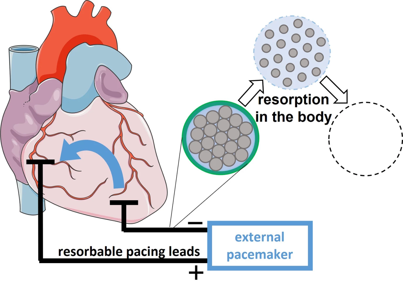 A diagram showing how the leads would degrade after a predetermined time period