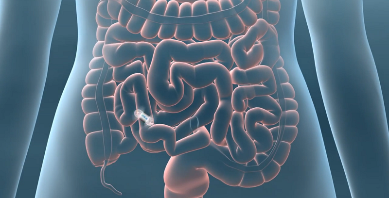 the PillCam Colon is a pill-sized video camera that patients swallow and passes through the gastrointestinal tract