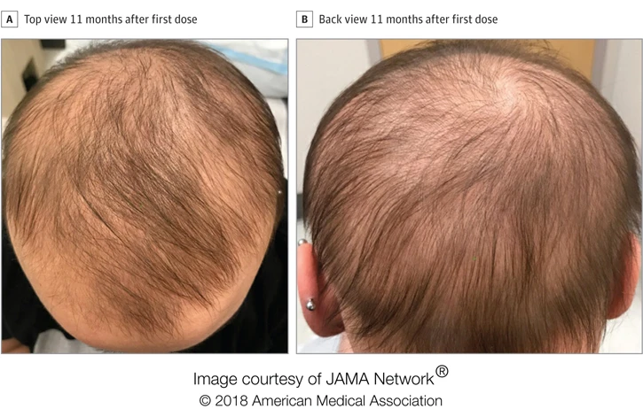 Top and back views, following 11 months of treatment