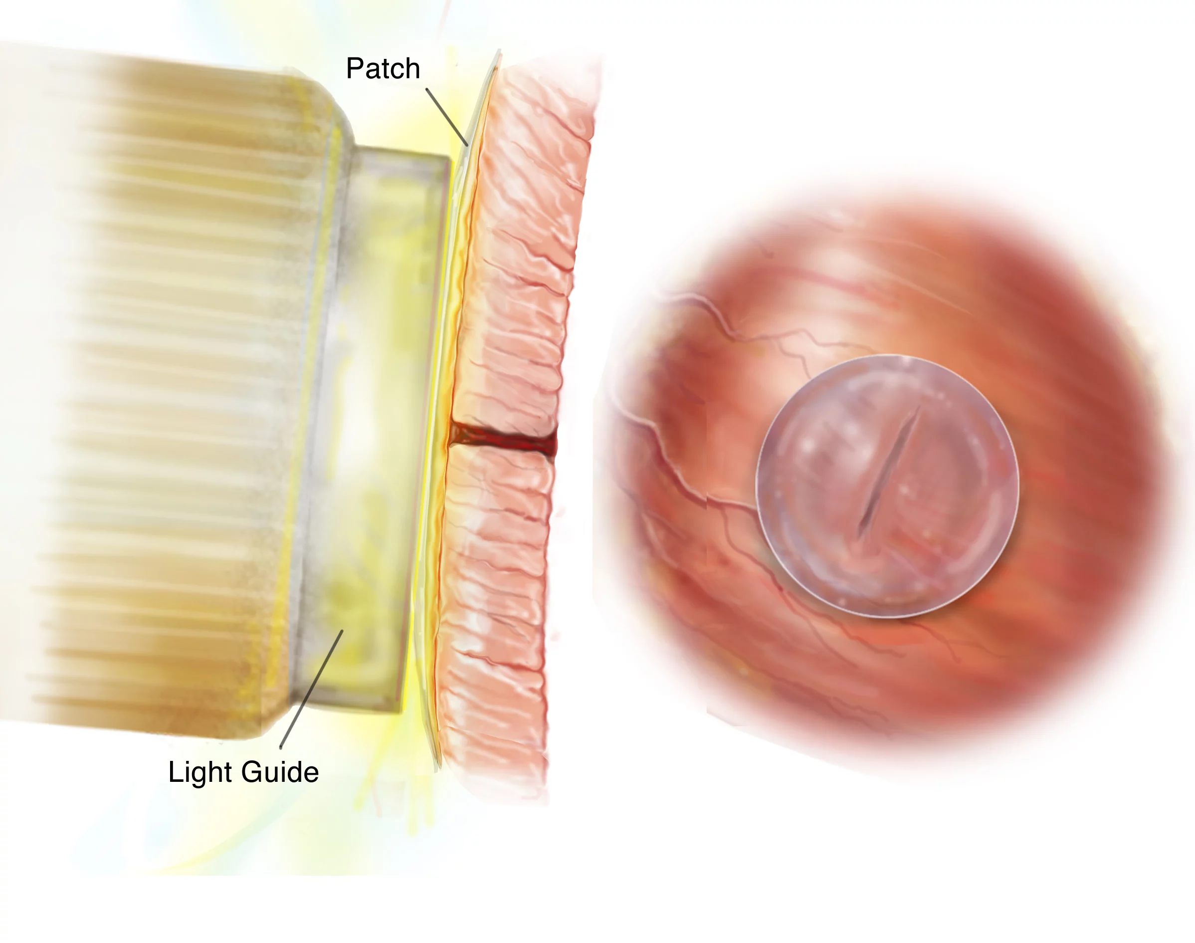 HLAA sets in just five seconds, once it's exposed to an ultraviolet light source
