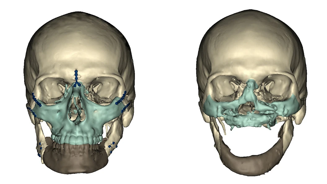 CT scan before and after surgery (Image: University of Maryland Medical Center)