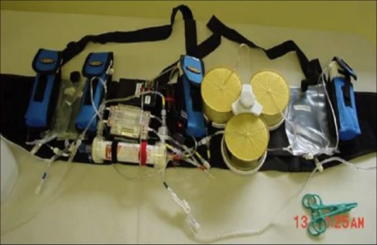 Wearable Artificial Kidney prototype