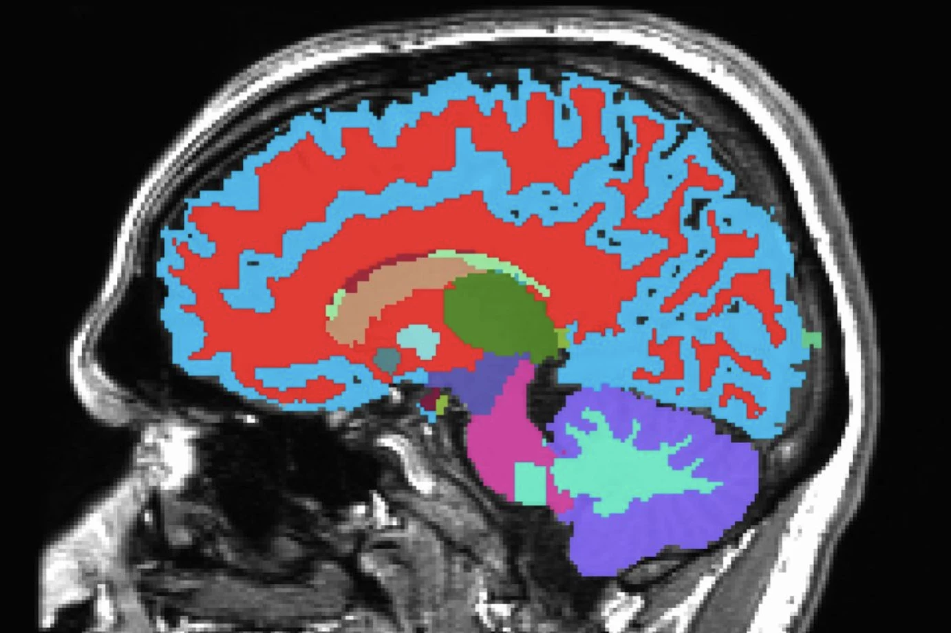 A single brain scan may reveal your aging rate and risk of dementia and disability years into the future