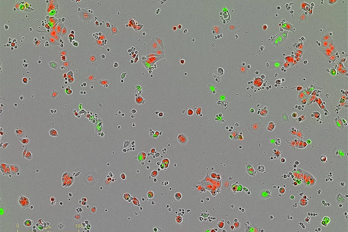 The study offers new insights into what triggers certain breast cancer cells to become dormant 'sleeper' cells (red) or remain active cancer cells (green).